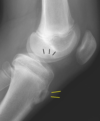 Osgood-Schlatter